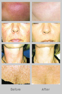 pigmented lesions treated by lasers